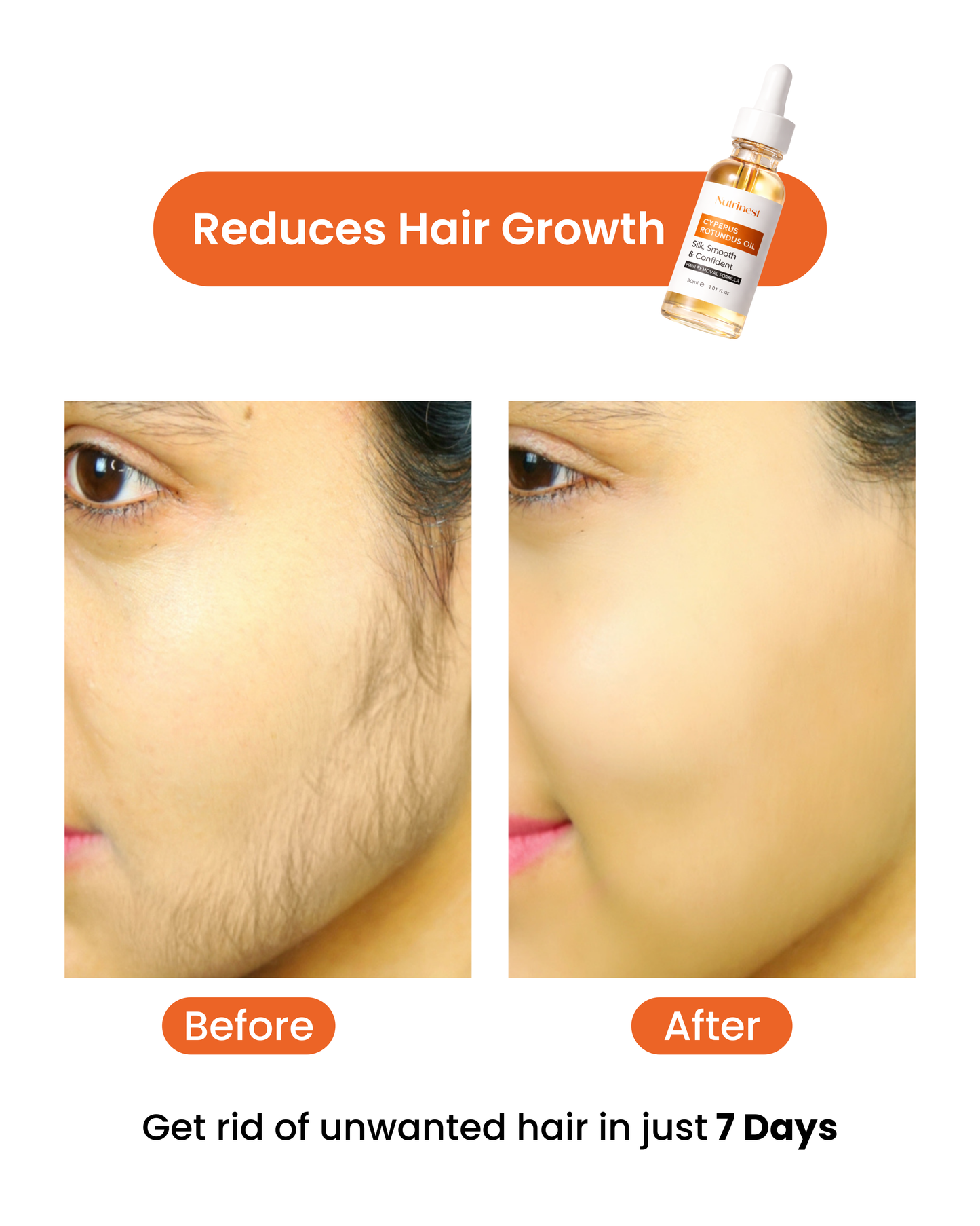 Cyperus Rotundus Oil for Hair Reduction