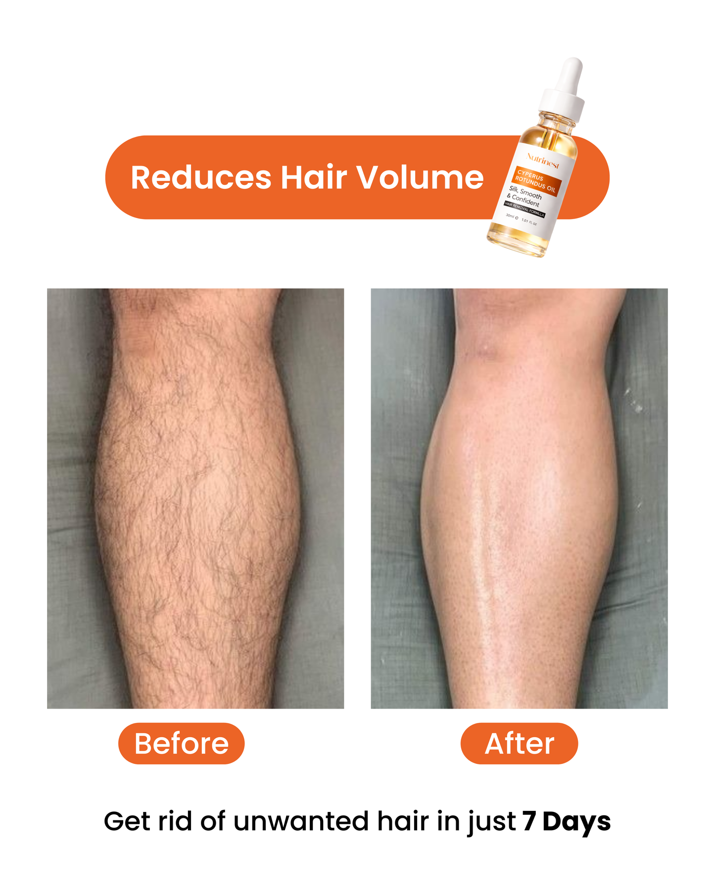 Cyperus Rotundus Oil for Hair Reduction