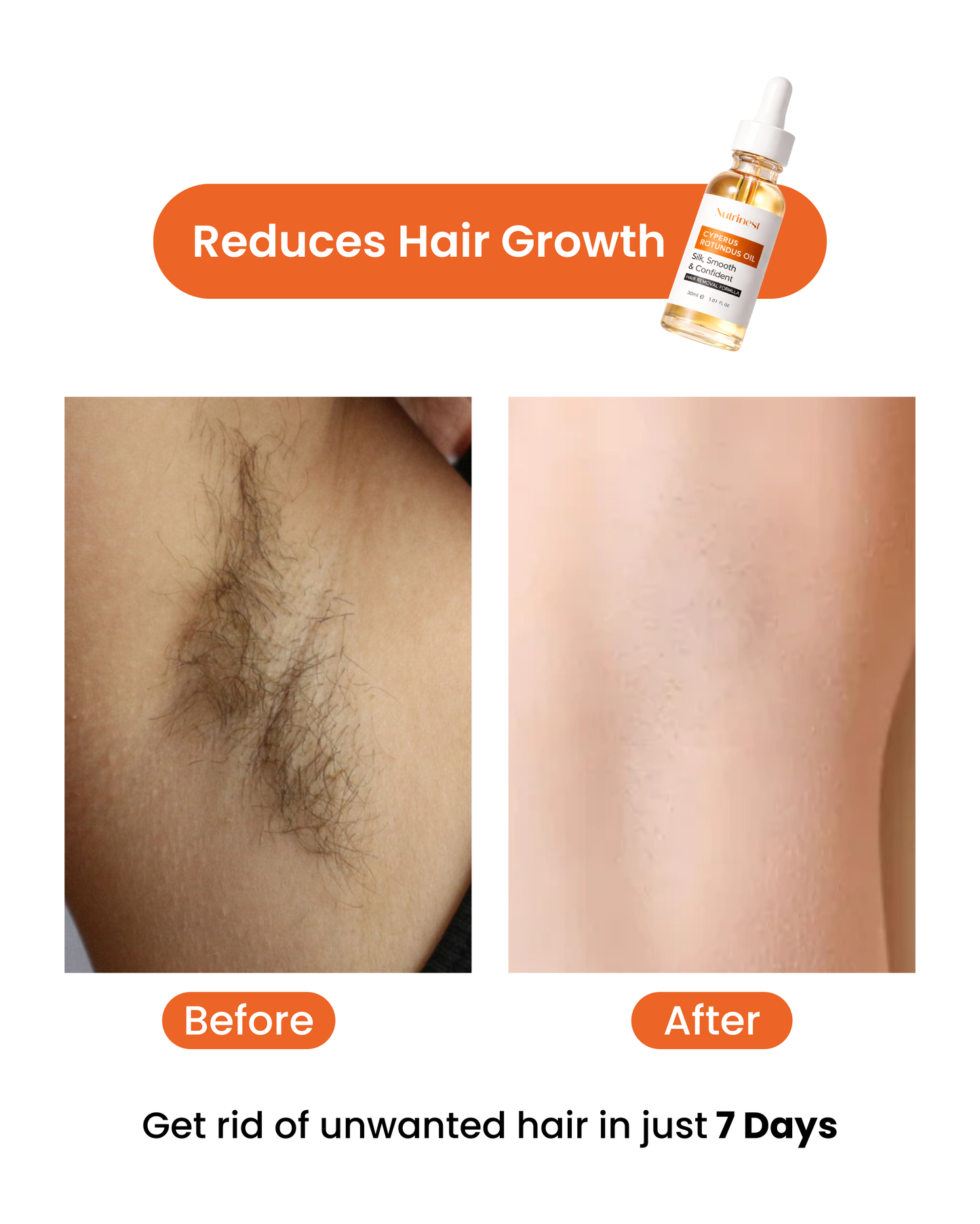 Cyperus Rotundus Oil for Hair Reduction