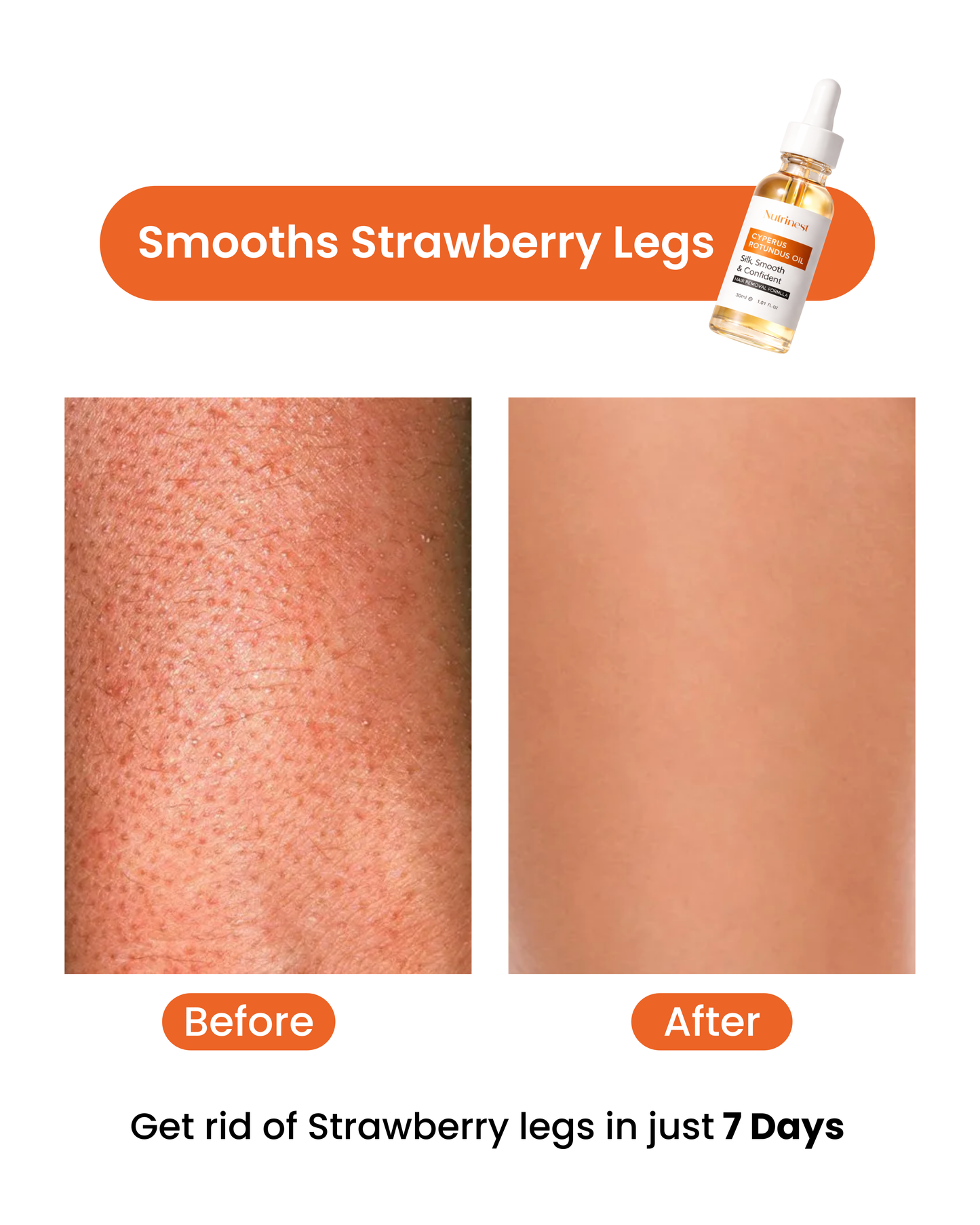 Cyperus Rotundus Oil for Hair Reduction