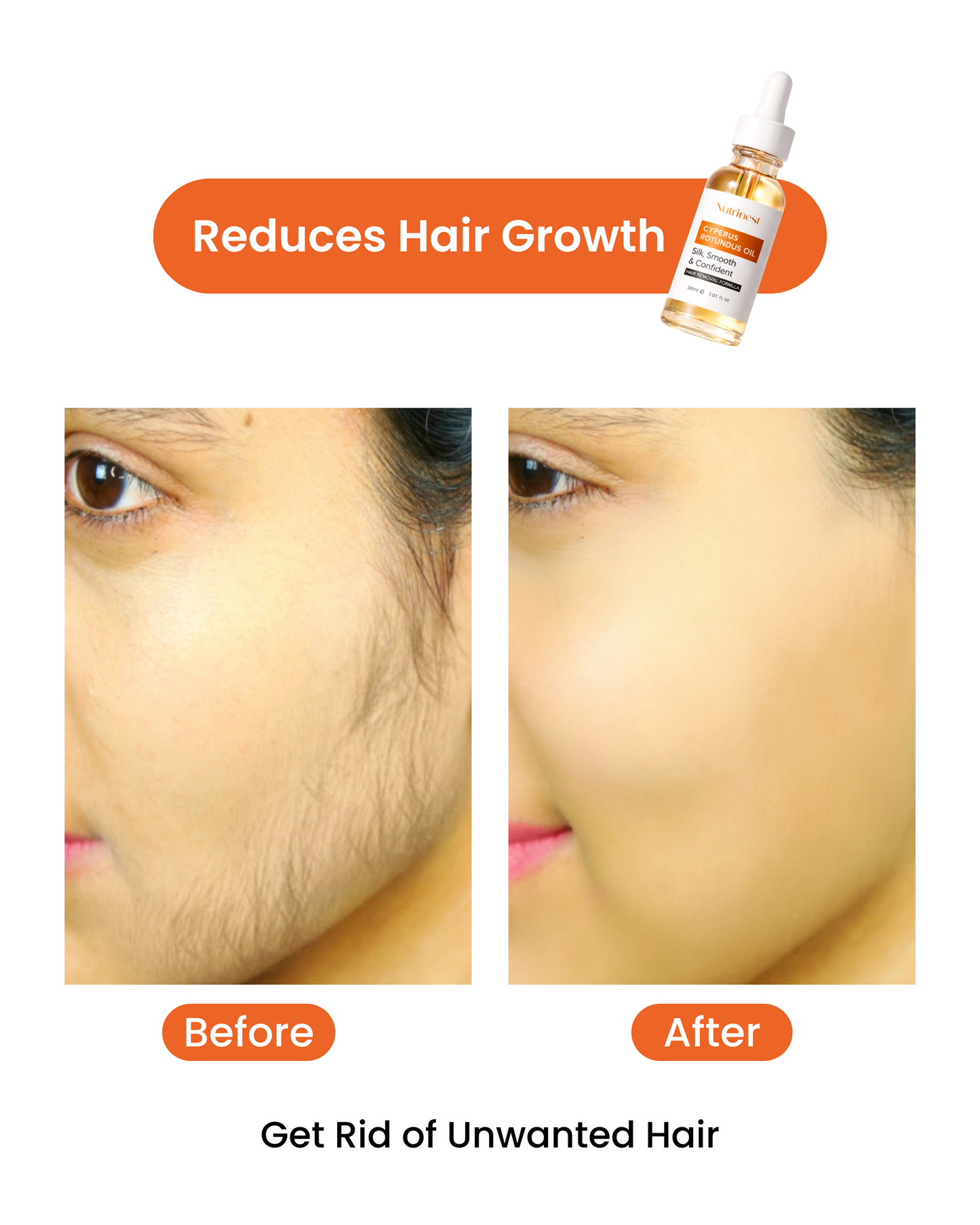 Cyperus Rotundus Oil for Hair Reduction