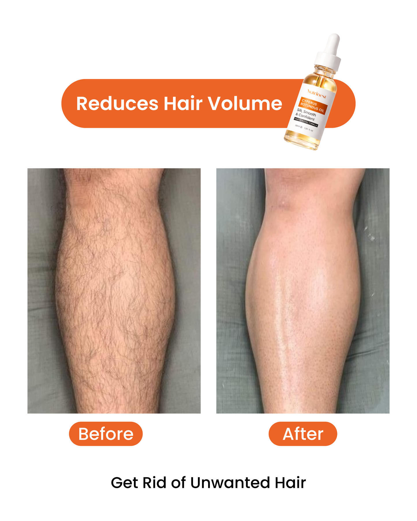 Cyperus Rotundus Oil for Hair Reduction